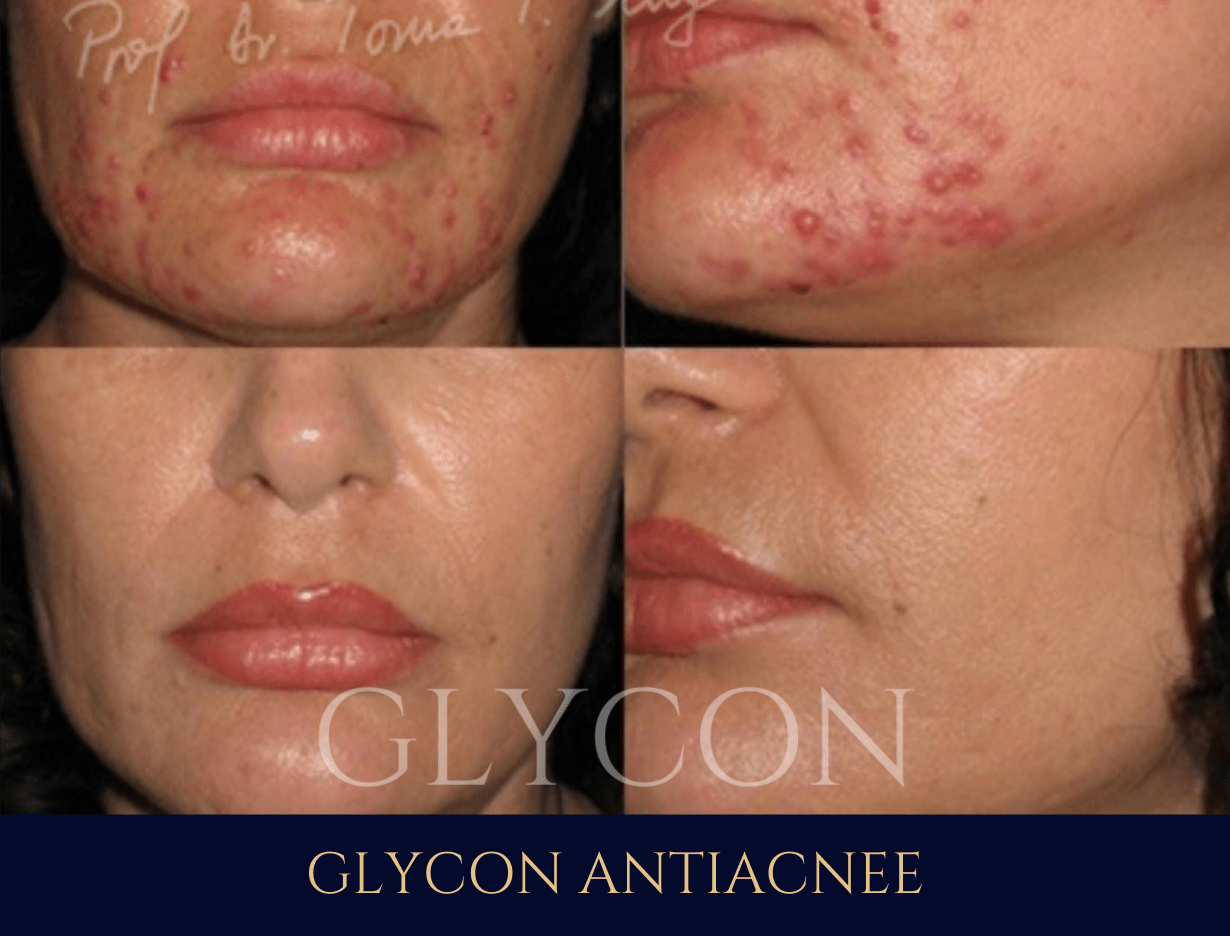 galerie foto inainte dupa tratament glycon antirid antiacnee acnee toma mugea